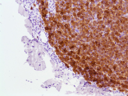 Immunohistochemistry (Formalin/PFA-fixed paraffin-embedded sections) - Anti-ALK antibody [SP8] (AB16670), expandable thumbnail