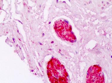 Immunohistochemistry (Formalin/PFA-fixed paraffin-embedded sections) - Anti-Alpha B Crystallin antibody (AB166839), expandable thumbnail