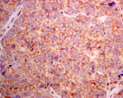 Immunohistochemistry (Formalin/PFA-fixed paraffin-embedded sections) - Anti-AMF antibody [EPR11663(B)] (AB167394)