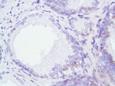 Immunohistochemistry (Formalin/PFA-fixed paraffin-embedded sections) - Anti-Androgen Receptor antibody [SP107] - N-terminal (ab105225), expandable thumbnail