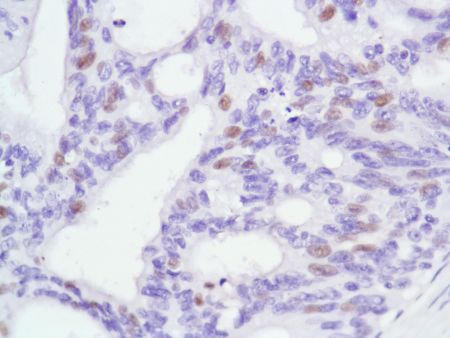 Immunohistochemistry (Formalin/PFA-fixed paraffin-embedded sections) - Anti-Androgen Receptor antibody [SP107] - N-terminal (ab105225), expandable thumbnail