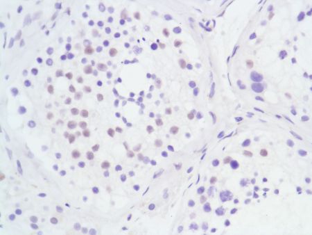 Immunohistochemistry (Formalin/PFA-fixed paraffin-embedded sections) - Anti-Androgen Receptor antibody [SP107] - N-terminal (ab105225), expandable thumbnail