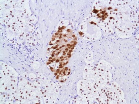 Immunohistochemistry (Formalin/PFA-fixed paraffin-embedded sections) - Anti-Androgen Receptor antibody [SP107] - N-terminal (ab105225), expandable thumbnail