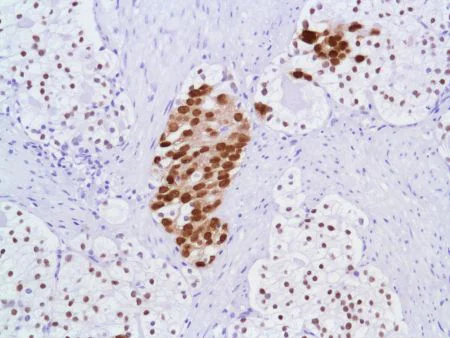 Immunohistochemistry (Formalin/PFA-fixed paraffin-embedded sections) - Anti-Androgen Receptor antibody [SP107] - N-terminal (AB105225)