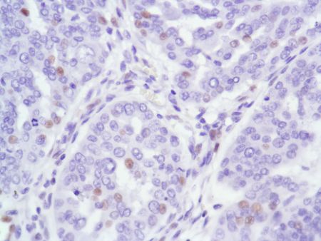 Immunohistochemistry (Formalin/PFA-fixed paraffin-embedded sections) - Anti-Androgen Receptor antibody [SP107] - N-terminal (AB105225), expandable thumbnail