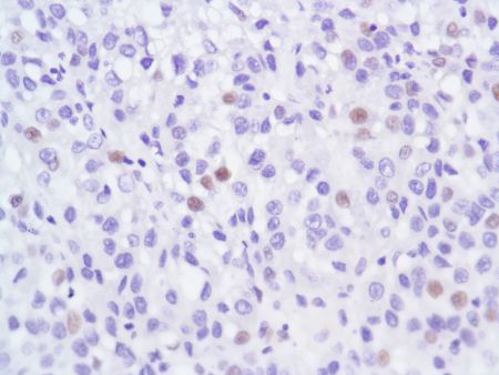 Immunohistochemistry (Formalin/PFA-fixed paraffin-embedded sections) - Anti-Androgen Receptor antibody [SP107] - N-terminal (ab105225), expandable thumbnail