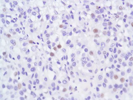 Immunohistochemistry (Formalin/PFA-fixed paraffin-embedded sections) - Anti-Androgen Receptor antibody [SP107] - N-terminal (AB105225)