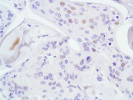Immunohistochemistry (Formalin/PFA-fixed paraffin-embedded sections) - Anti-Androgen Receptor antibody [SP107] - N-terminal (ab105225), expandable thumbnail