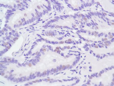 Immunohistochemistry (Formalin/PFA-fixed paraffin-embedded sections) - Anti-Androgen Receptor antibody [SP107] - N-terminal (ab105225), expandable thumbnail