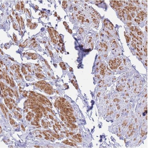Immunohistochemistry (Formalin/PFA-fixed paraffin-embedded sections) - Anti-ASAP3 antibody (AB187885), expandable thumbnail