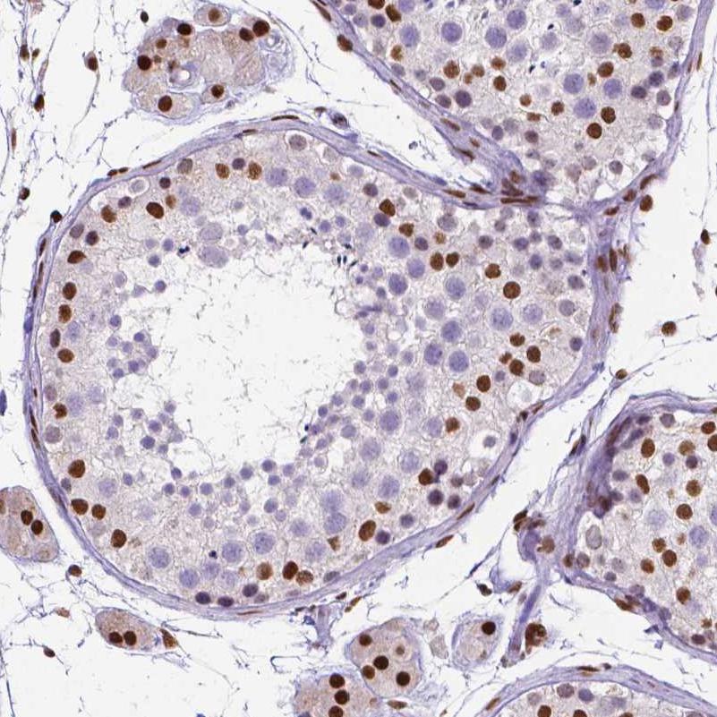 Immunohistochemistry (Formalin/PFA-fixed paraffin-embedded sections) - Anti-ATRX antibody [CL0537] (ab188027), expandable thumbnail