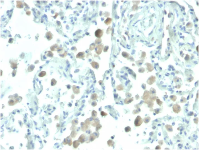 Immunohistochemistry (Formalin/PFA-fixed paraffin-embedded sections) - Biotin Anti-Mesothelin antibody [MSLN/2131] (AB271813)