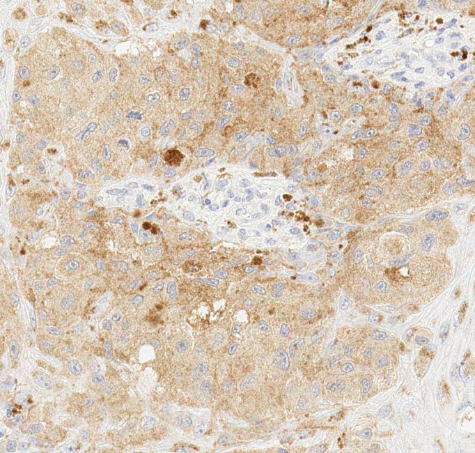 Immunohistochemistry (Formalin/PFA-fixed paraffin-embedded sections) - Anti-BRAF (mutated V600E) antibody [VE1] - BSA and Azide free (AB324341), expandable thumbnail