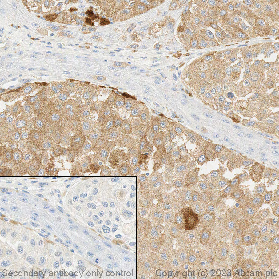 Immunohistochemistry (Formalin/PFA-fixed paraffin-embedded sections) - Anti-BRAF (mutated V600E) antibody [VE1] - BSA and Azide free (AB324341), expandable thumbnail