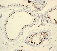 Immunohistochemistry (Formalin/PFA-fixed paraffin-embedded sections) - Anti-BRG1 antibody [EPNCIR111A] (ab110641), expandable thumbnail