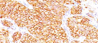 Immunohistochemistry (Formalin/PFA-fixed paraffin-embedded sections) - Anti-Carbonic Anhydrase 9/CA9 antibody [66.4.C2/PN-15] (AB187365)