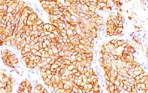 Immunohistochemistry (Formalin/PFA-fixed paraffin-embedded sections) - Anti-Carbonic Anhydrase 9/CA9 antibody [66.4.C266.4.C2/PN-15] - BSA and Azide free (AB212959)