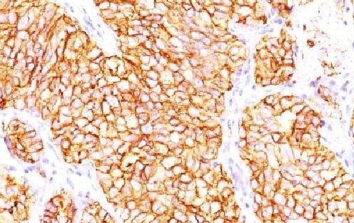 Immunohistochemistry (Formalin/PFA-fixed paraffin-embedded sections) - Anti-Carbonic Anhydrase 9/CA9 antibody [66.4.C266.4.C2/PN-15] - BSA and Azide free (AB212959)
