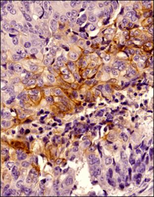 Immunohistochemistry (Formalin/PFA-fixed paraffin-embedded sections) - Anti-Carbonic Anhydrase 9/CA9 antibody (AB15086)