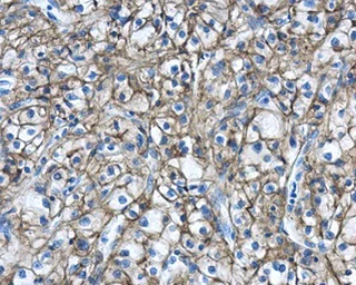 Immunohistochemistry (Formalin/PFA-fixed paraffin-embedded sections) - Anti-Carbonic Anhydrase 9/CA9 antibody (AB184006)