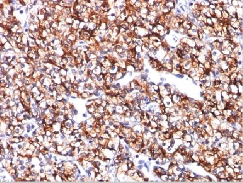 Immunohistochemistry (Formalin/PFA-fixed paraffin-embedded sections) - Anti-Carbonic Anhydrase 9/CA9 antibody [CA9/781] (AB216021)