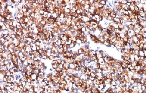Immunohistochemistry (Formalin/PFA-fixed paraffin-embedded sections) - Anti-Carbonic Anhydrase 9/CA9 antibody [CA9/781] - BSA and Azide free (AB212962)