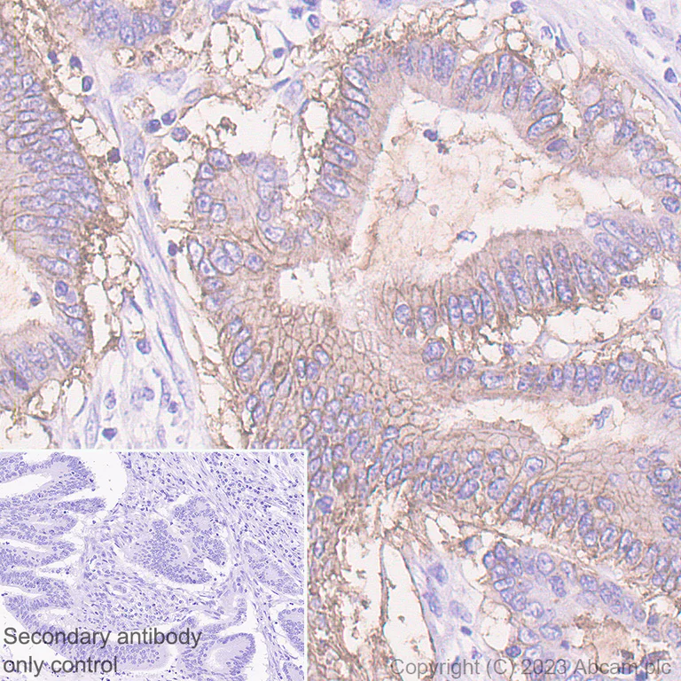 Immunohistochemistry (Formalin/PFA-fixed paraffin-embedded sections) - Anti-Carbonic Anhydrase 9/CA9 antibody [EPR23055-5] (AB243660)