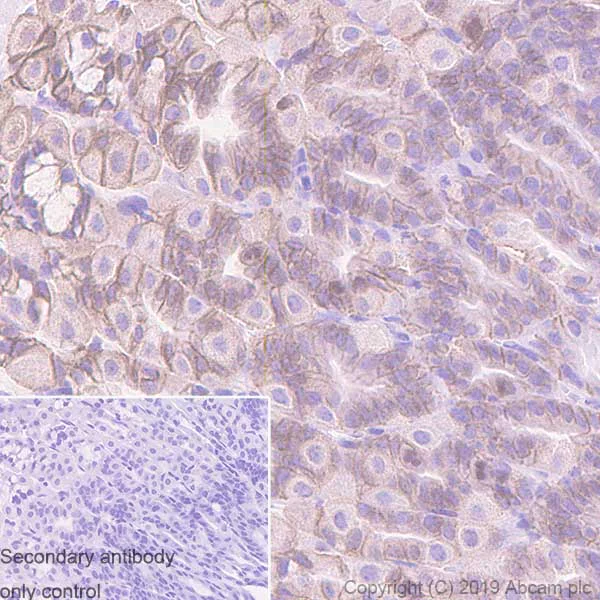 Immunohistochemistry (Formalin/PFA-fixed paraffin-embedded sections) - Anti-Carbonic Anhydrase 9/CA9 antibody [EPR23055-5] - BSA and Azide free (AB270401)