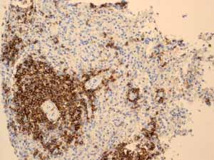 Immunohistochemistry (Formalin/PFA-fixed paraffin-embedded sections) - Anti-CD20 antibody [EP459Y] - Low endotoxin, Azide free (ab166865), expandable thumbnail