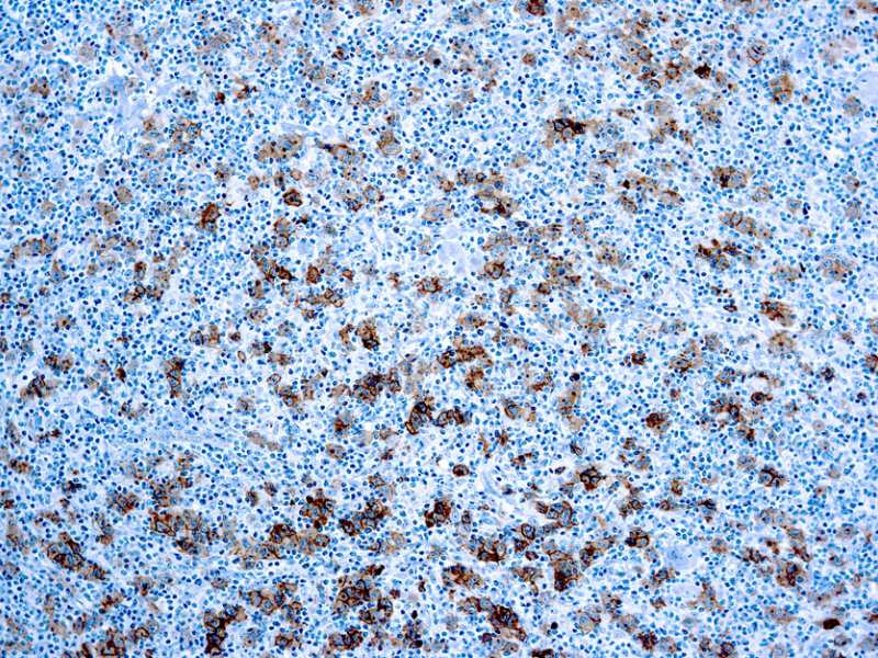Immunohistochemistry (Formalin/PFA-fixed paraffin-embedded sections) - Anti-CD30 antibody [Ber-H2], prediluted (AB871), expandable thumbnail