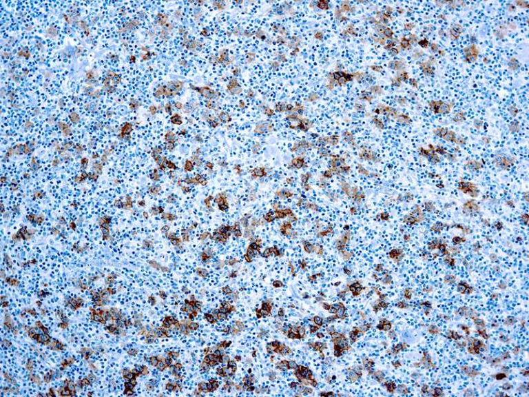 Immunohistochemistry (Formalin/PFA-fixed paraffin-embedded sections) - Anti-CD30 antibody [Ber-H2], prediluted (AB871)