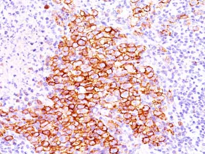 Immunohistochemistry (Formalin/PFA-fixed paraffin-embedded sections) - Anti-CD30 antibody [CD30/412] - BSA and Azide free (AB213047), expandable thumbnail