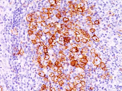 Immunohistochemistry (Formalin/PFA-fixed paraffin-embedded sections) - Anti-CD30 antibody [CD30/412] - BSA and Azide free (AB213047), expandable thumbnail