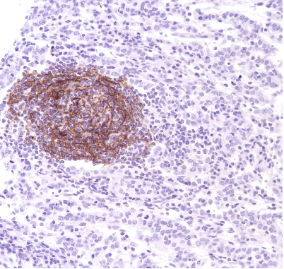 Immunohistochemistry (Formalin/PFA-fixed paraffin-embedded sections) - Anti-CD35 antibody [SP191] (AB227666)