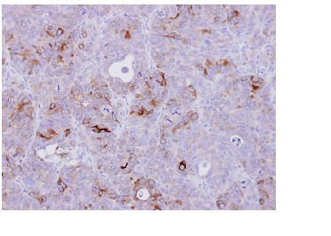 Immunohistochemistry (Formalin/PFA-fixed paraffin-embedded sections) - Anti-CD74 antibody (AB97479), expandable thumbnail