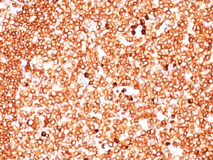 Immunohistochemistry (Formalin/PFA-fixed paraffin-embedded sections) - Anti-CD79a antibody [JCB117 + HM47A9] (AB199001), expandable thumbnail