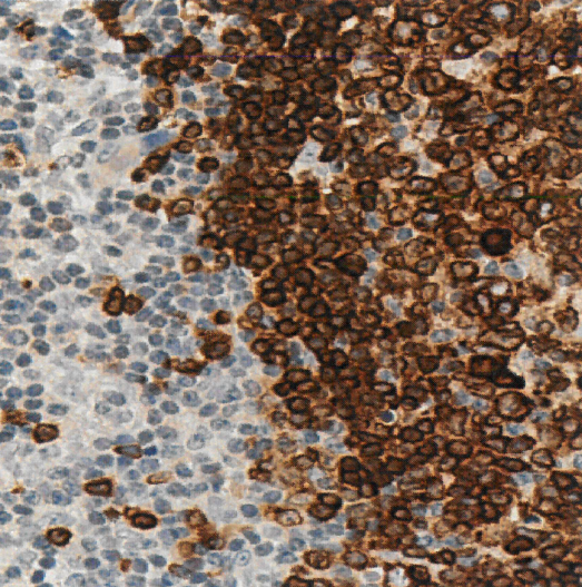 Immunohistochemistry (Formalin/PFA-fixed paraffin-embedded sections) - Anti-CD79a antibody [SP18] (AB16698), expandable thumbnail