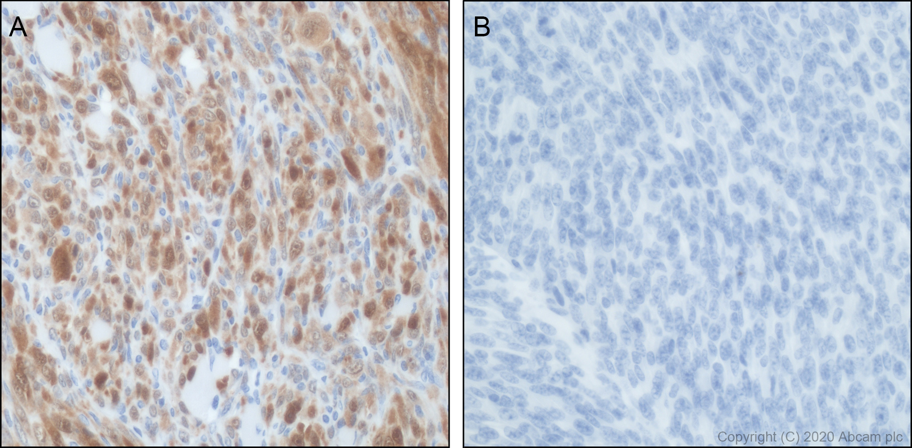 Immunohistochemistry (Formalin/PFA-fixed paraffin-embedded sections) - Anti-CDKN2A/p16INK4a antibody [PABLO33B] (AB241543)