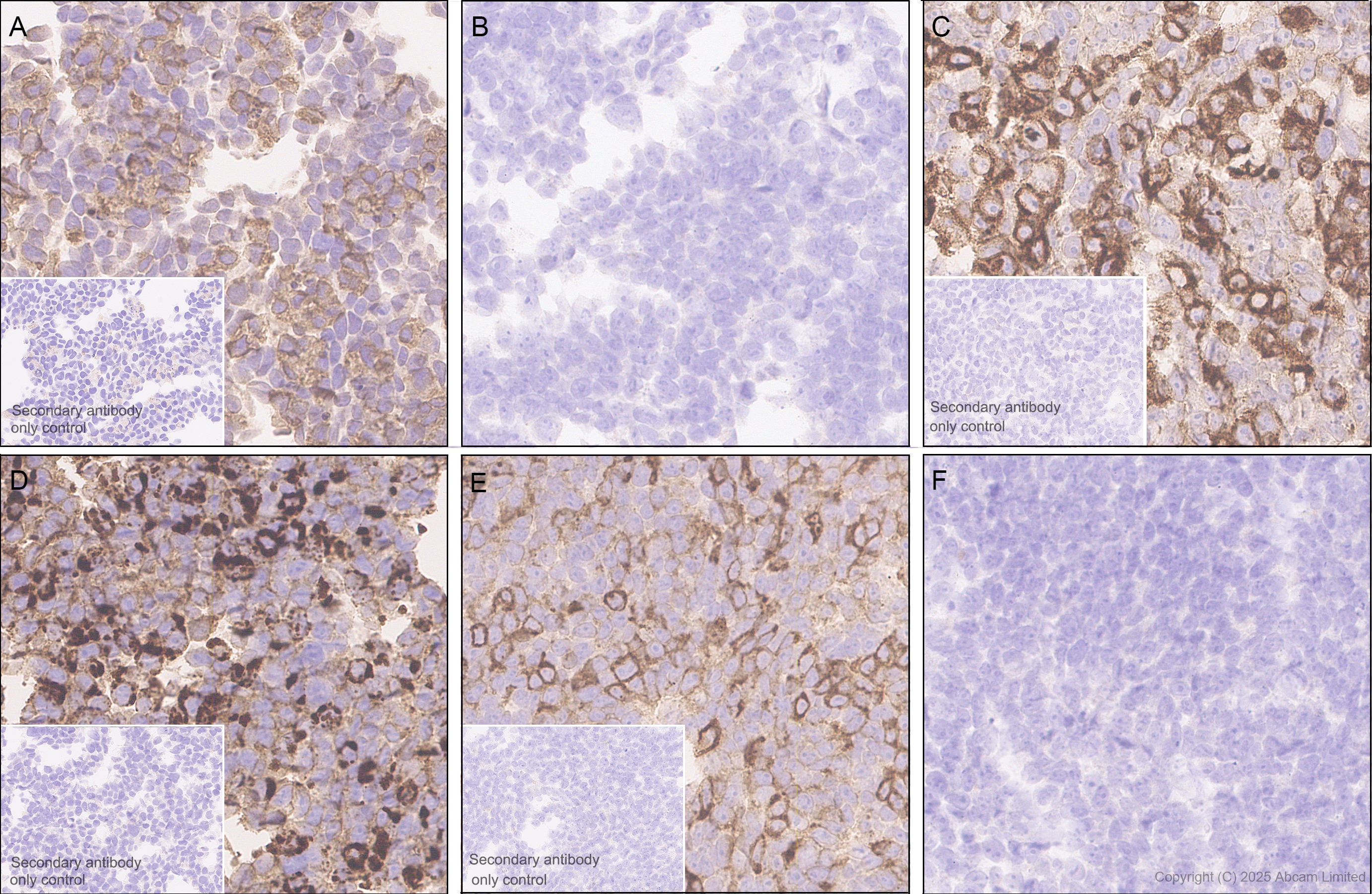 Immunohistochemistry (Formalin/PFA-fixed paraffin-embedded sections) - Anti-CEACAM1+ CEACAM5 + CEACAM6 + CEACAM8 antibody  [RM1195] (ab323805), expandable thumbnail
