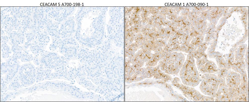 Immunohistochemistry (Formalin/PFA-fixed paraffin-embedded sections) - Anti-CEACAM5 antibody [BLR198J] - BSA free (ab314055), expandable thumbnail