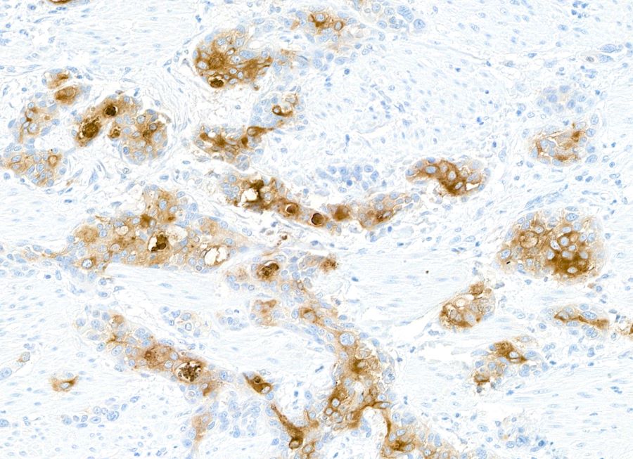 Immunohistochemistry (Formalin/PFA-fixed paraffin-embedded sections) - Anti-CEACAM5 antibody [BLR198J] - BSA free (AB314055), expandable thumbnail