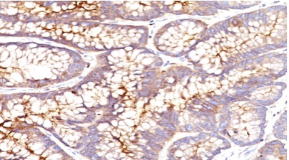 Immunohistochemistry (Formalin/PFA-fixed paraffin-embedded sections) - Anti-CEACAM5 antibody [CEA31] (AB193372)