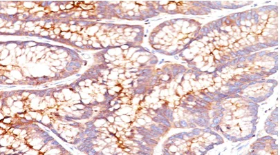 Immunohistochemistry (Formalin/PFA-fixed paraffin-embedded sections) - Anti-CEACAM5 antibody [CEA31] (AB193372)