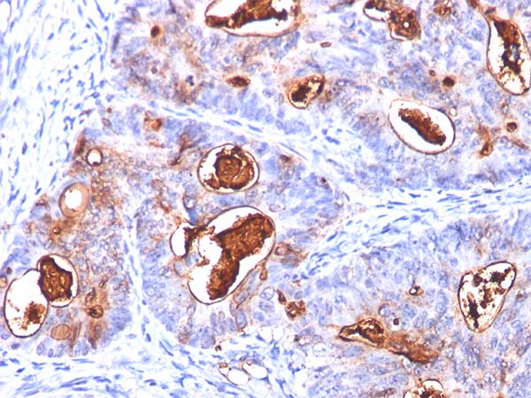Immunohistochemistry (Formalin/PFA-fixed paraffin-embedded sections) - Anti-CEACAM5 antibody [COL-1 + CEA31 + C66/26] (AB201328)