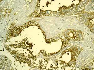 Immunohistochemistry (Formalin/PFA-fixed paraffin-embedded sections) - Anti-CEACAM5 antibody [EPCEAR7] - BSA and Azide free (AB226144)