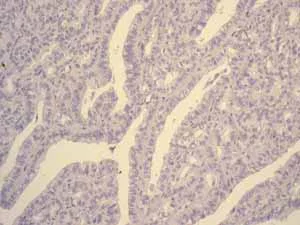 Immunohistochemistry (Formalin/PFA-fixed paraffin-embedded sections) - Anti-CEACAM5 antibody [EPCEAR7] - BSA and Azide free (AB226144)