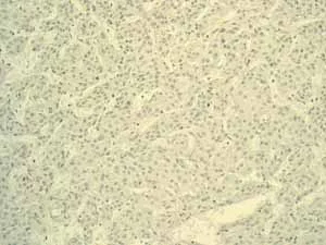 Immunohistochemistry (Formalin/PFA-fixed paraffin-embedded sections) - Anti-CEACAM5 antibody [EPCEAR7] - BSA and Azide free (AB226144)