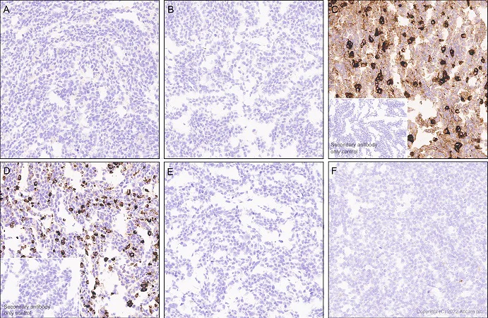 Immunohistochemistry (Formalin/PFA-fixed paraffin-embedded sections) - Anti-CEACAM5 antibody [EPCEAR7] - BSA and Azide free (AB226144)