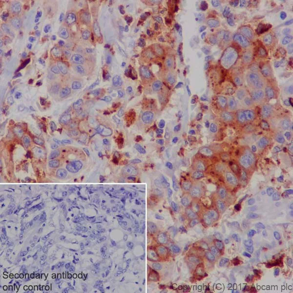 Immunohistochemistry (Formalin/PFA-fixed paraffin-embedded sections) - Anti-CEACAM5 + CD66b + CEACAM1 + CEACAM6 antibody [EPR20721] (AB207718)