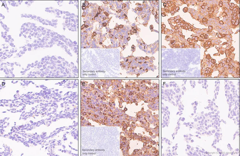 Immunohistochemistry (Formalin/PFA-fixed paraffin-embedded sections) - Anti-CEACAM5 + CD66b + CEACAM1 + CEACAM6 antibody [EPR20721] (AB207718)